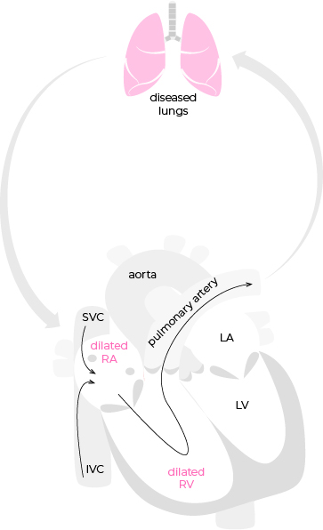 chronic lung disease diagram